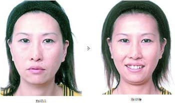 共立美容外科の目の下のふくらみ（脂肪）取りの症例