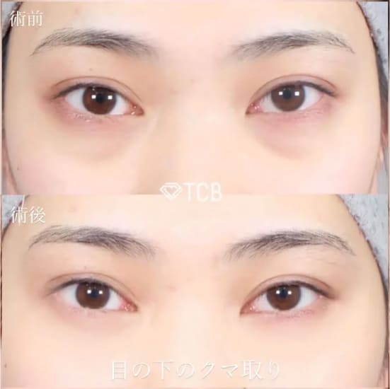 TCB東京中央美容外科の切らない目の下のクマ・目の下のたるみ（ふくらみ）取りの症例