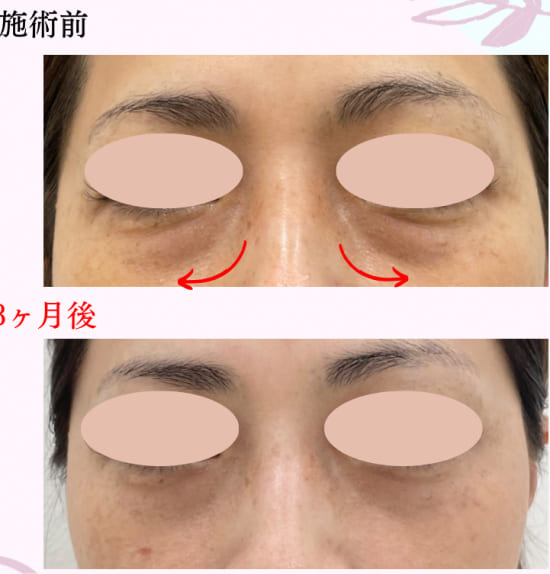 クララ美容皮膚科の目の下のふくらみ取り（脱脂術）両側の症例