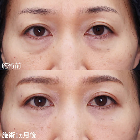 TAクリニックの下眼瞼脱脂術/目の下へのヒアルロン酸注入の症例