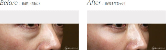 聖心美容クリニックのハムラ法+α（Ver.2）/プレミアムPRP皮膚再生療法の症例