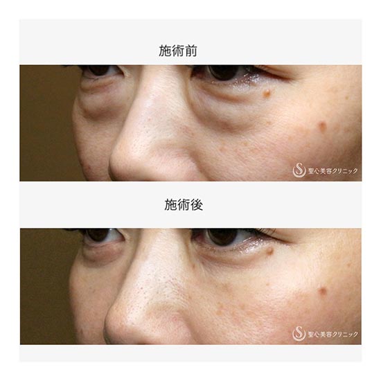 聖心美容クリニックの下眼瞼切開術・下眼瞼除皺術・ハムラ法＋プレミアムPRP皮膚再生療法の症例