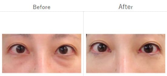 渋谷美容外科クリニックの下眼瞼脱脂の症例