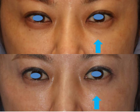 宮益坂クリニックの経結膜下眼瞼脱脂術（眼窩脂肪除去）の症例