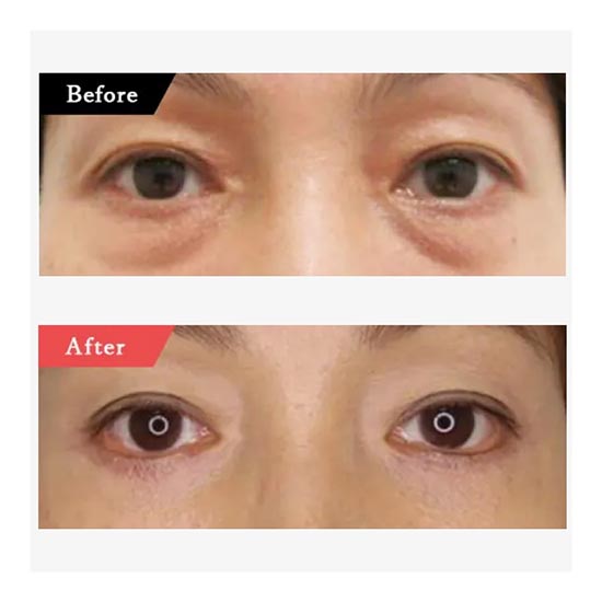 TAクリニックの下眼瞼脱脂術（クマ・ふくらみとり）・下眼瞼切開術（クマ・たるみとり）の症例
