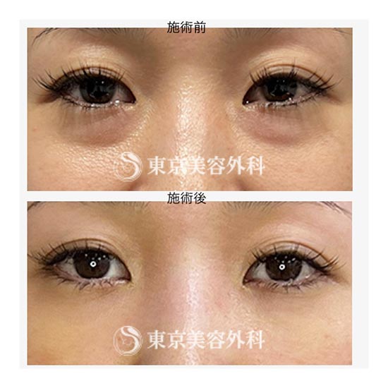東京美容外科の切らない目の下のクマ・たるみ取り　経結膜アプローチ法の症例
