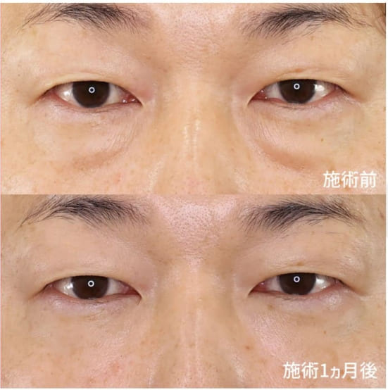TAクリニックの下眼瞼脱脂術　裏ハムラ法　1ヵ月後の症例