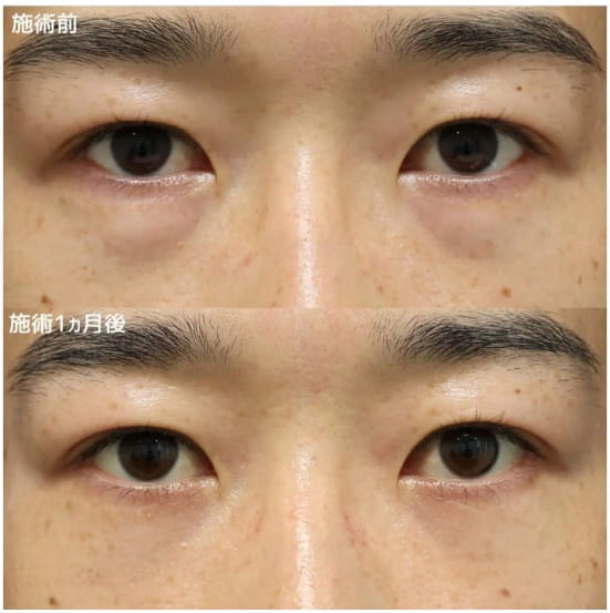 TAクリニックの下眼瞼脱脂術　1ヵ月後の症例