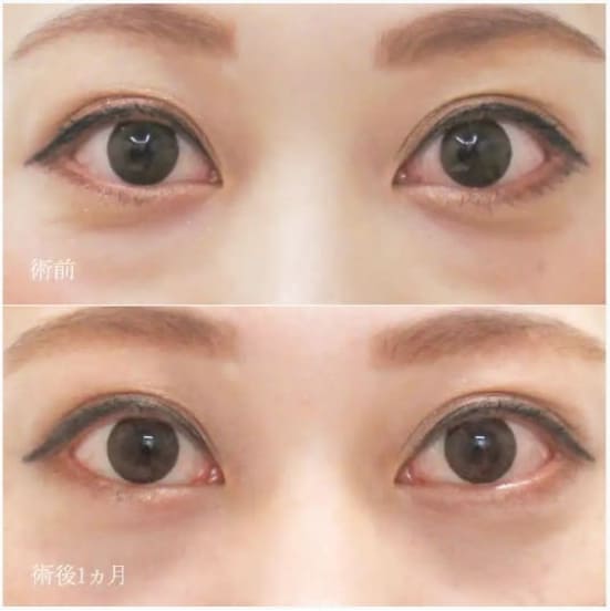 水の森美容クリニックの下眼瞼脱脂（目の下の脂肪取り）1ヵ月後の症例