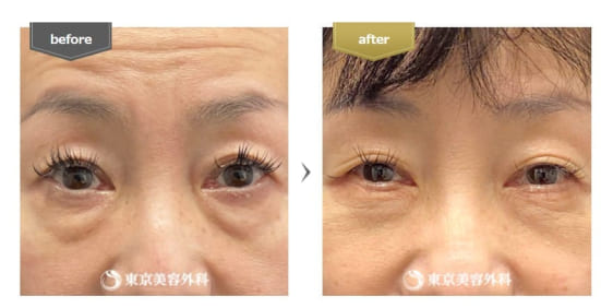 東京美容外科の目の下のたるみ取り（ハムラ法）の症例