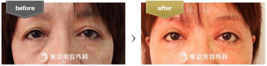 東京美容外科の目の下脂肪再配置（裏ハムラ法）の症例