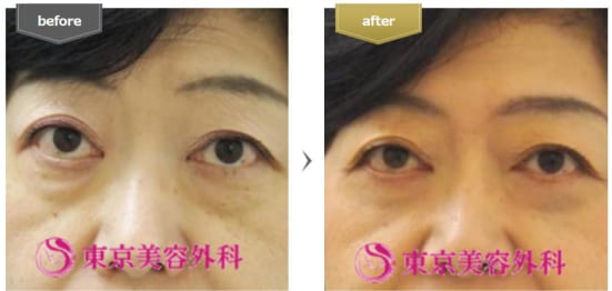東京美容外科の目の下のたるみ取り（皮膚切除）の症例