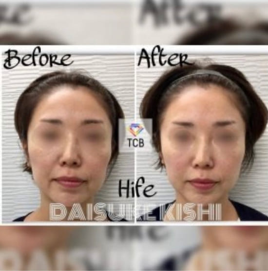 TCB東京中央美容外科の医療ハイフ（HIFU）の症例