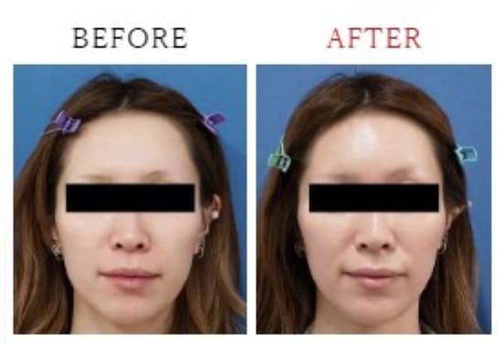もとび美容外科クリニックのHIFU（ハイフ）顔全体　1週間後の症例