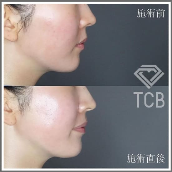 TCB東京中央美容外科のTCB医療ハイフの症例