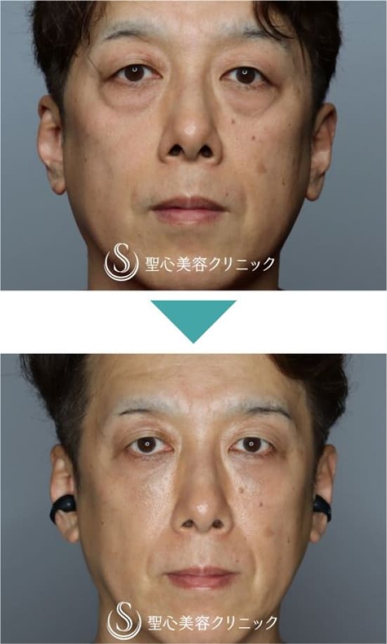 聖心美容クリニックのプレミアムPRP皮膚再生療法＋結膜側脱脂の症例