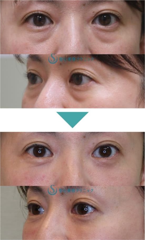 聖心美容クリニックの目の下の脱脂＋プレミアムPRP皮膚再生療法の症例