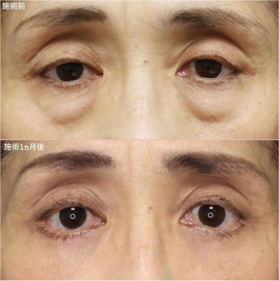 TAクリニックの下眼切開術の症例
