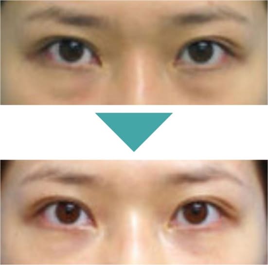 ガーデンクリニックの下瞼脱脂法の症例