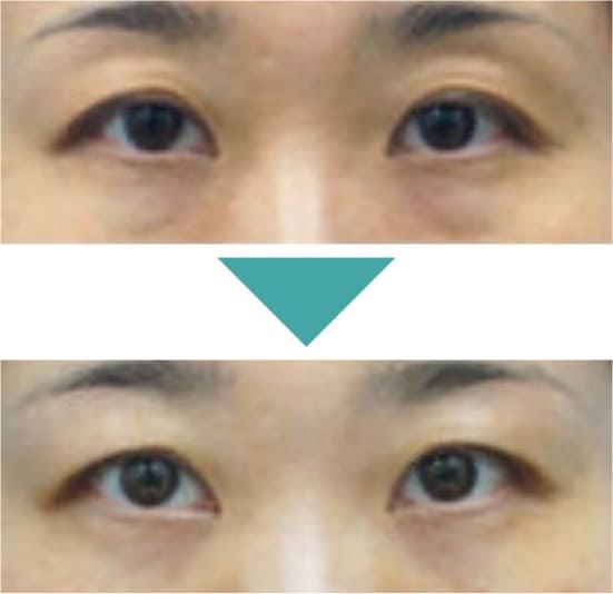 ガーデンクリニックの下瞼脱脂法の症例