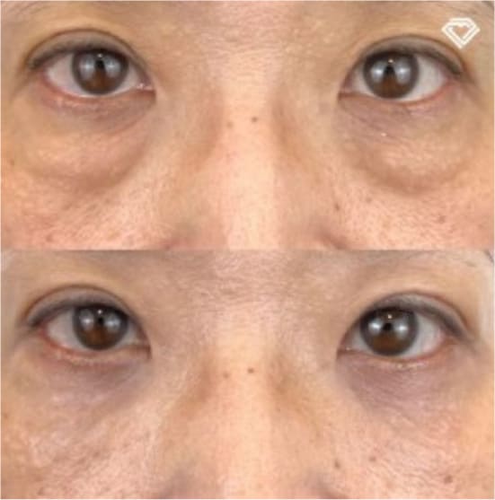 TCB東京中央美容外科の切らない目の下のクマ取り・目の下のたるみ（ふくらみ）取りの症例