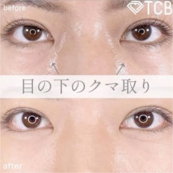 TCB東京中央美容外科の切らない目の下のクマ取り・目の下のたるみ（ふくらみ）取りの症例