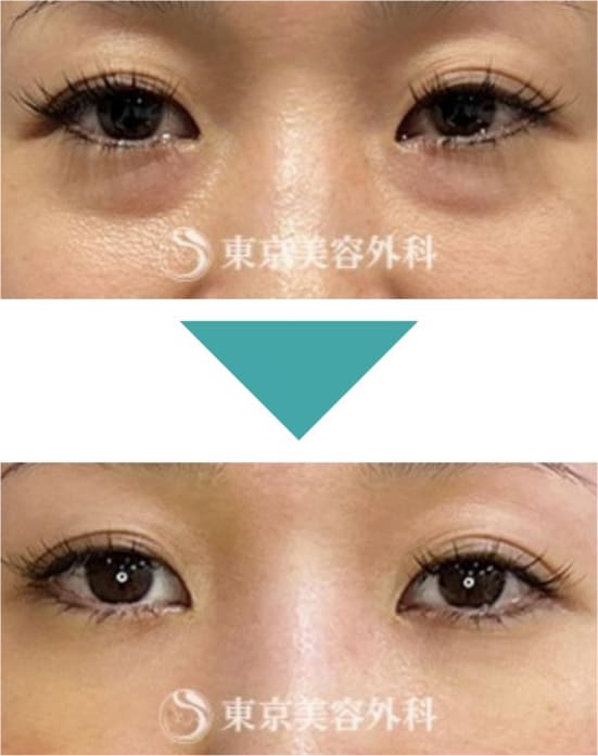 東京美容外科の切らない目の下のクマ・たるみ取り（経結膜アプローチ法）の症例