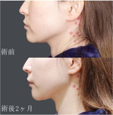 水の森美容クリニックの医療HIFU（ウルトラフォーマーMPT）全顔+顎下（680ショット）の症例