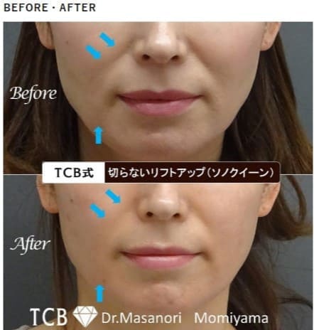 TCB東京中央美容外科の医療ハイフ（HIFU）の症例