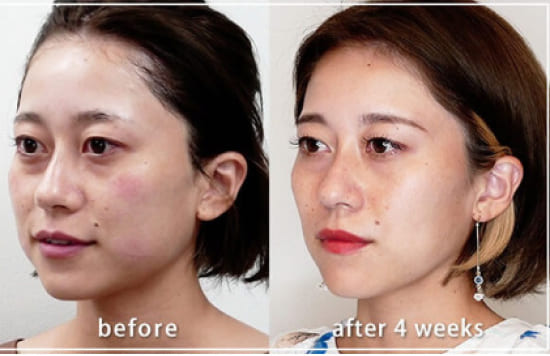 共立美容外科のスーパーハイフプロ/エラボトックスの症例