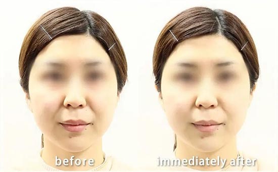 共立美容外科のSuper”HIFU”Proの症例