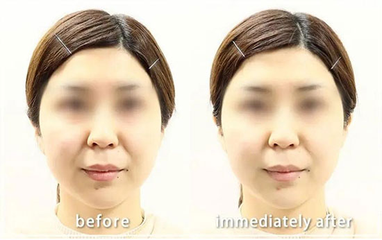 共立美容外科のSuper”HIFU”Proの症例
