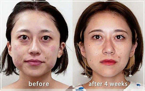 共立美容外科のSuper”HIFU”Pro								の症例