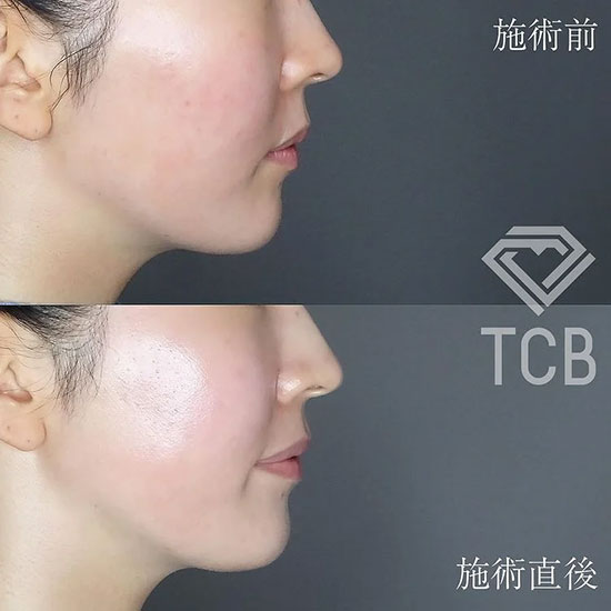 TCB東京中央美容外科の医療ハイフ（ソノクイーン）の症例