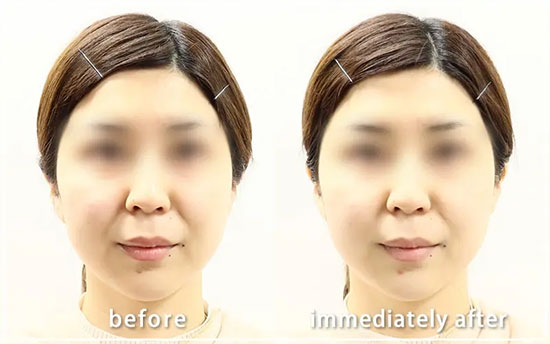 共立美容外科のスーパーハイフプロの症例