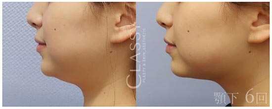 CLASSY 仙台美容外科・美容皮膚科のウルトラセルQプラスの症例