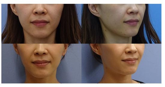 CLASSY 仙台美容外科・美容皮膚科のウルトラセルQプラスの症例