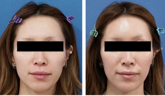 もとび美容外科クリニックのHIFU（ハイフ）顔全体の症例