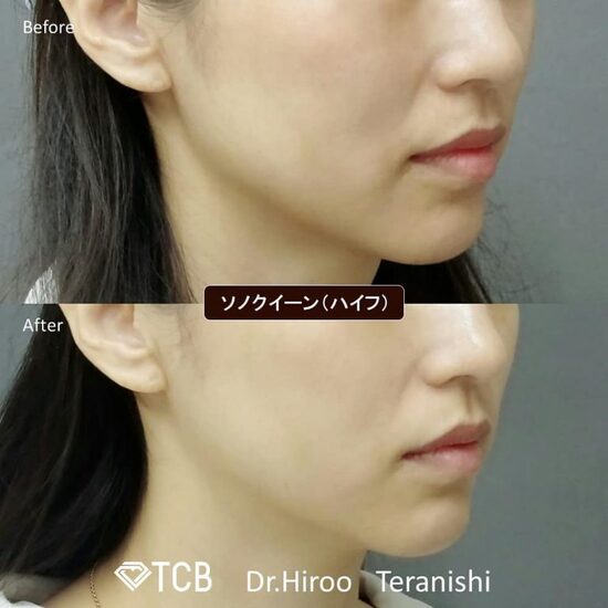 TCB東京中央美容外科の医療ハイフの症例