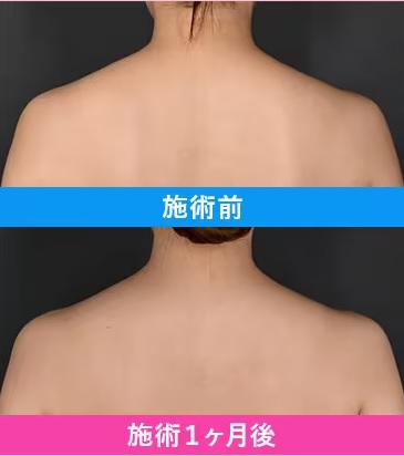 湘南美容クリニックの肩ボトックス・肩こりボトックスの症例