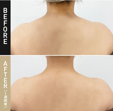 TAクリニックの肩ボトックス注射の症例