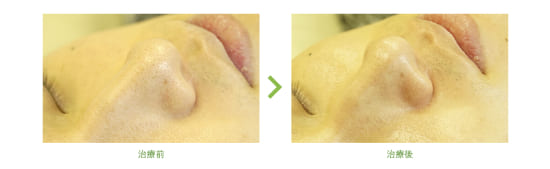 オラクル美容皮膚科のハイドラフェイシャル1回治療の症例