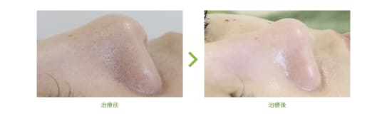 オラクル美容皮膚科のハイドラフェイシャル1回治療の症例