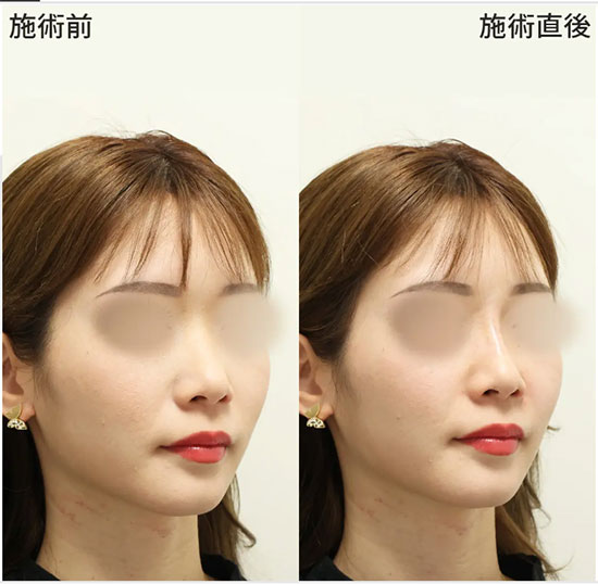 ヒアルロン酸による切らない鼻の整形施術の症例写真