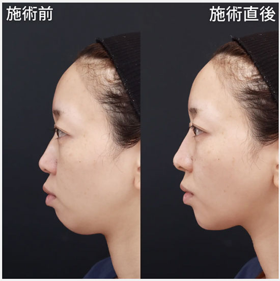 糸リフトによる切らない鼻の整形施術の症例写真