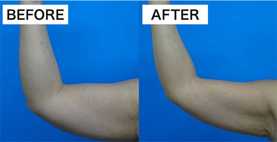 脂肪溶解注射　二の腕　TCB　症例写真