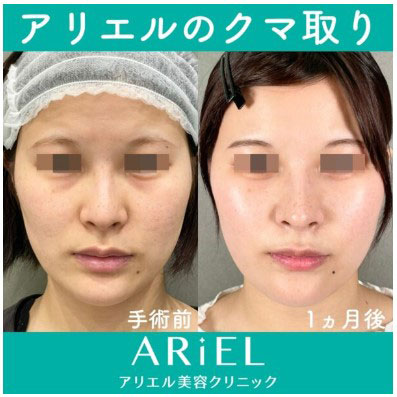 アリエル美容クリニックの目の下のたるみ取り、目の下の脂肪注入の症例