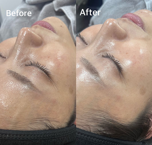 ララピール - 大阪心斎橋・南船場の美容皮膚科ならメディカルアルファ