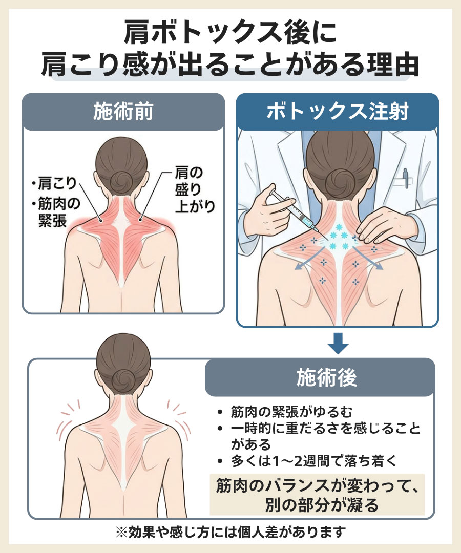 肩ボトックス後に肩こり感が出ることがある理由